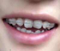 戴隐形牙套矫正牙齿前后对比图——成都圣贝牙科医院