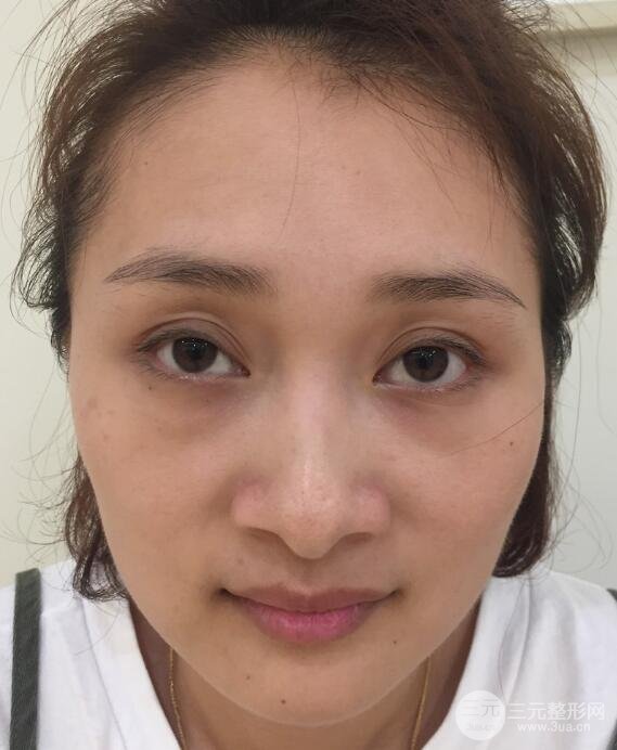 去西京医院做超声法去眼袋手术后六天照片真人案例