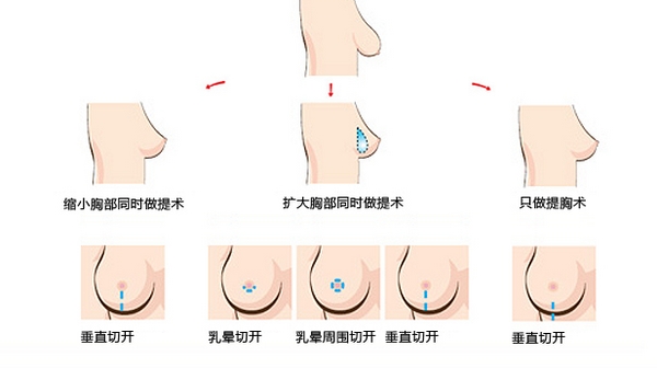 深圳美莱整形做乳房下垂矫正手术需要花多少钱?注意什么?