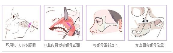 磨颧骨手术示例图