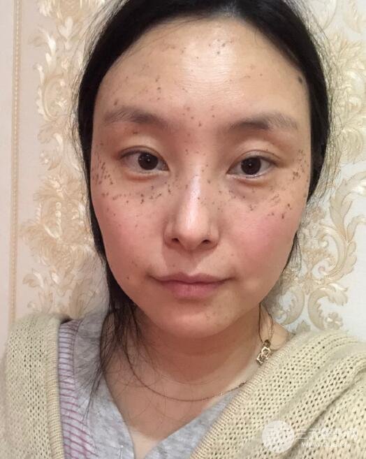扬州苏北医院美容科去痣效果图对比 激光祛痣经验