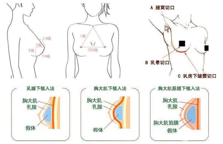 c罩杯多大胸图片欣赏丨胸部整形手术之后需要注意什么