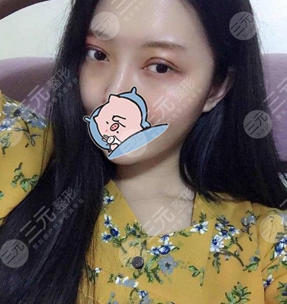 沈阳杏林张莹莹医生怎么样?附网友高清双眼皮修复图片