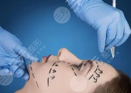 整容面部拉皮手术图拉皮手术的果原理及真人果反馈