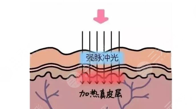 深圳光子嫩肤三甲医院top3北大深圳医院人民医院等你pick哪家