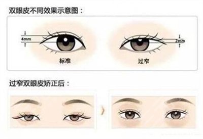 上海五官科整形医院双眼皮案例