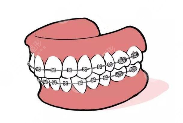 主要用于固定正畸的钢丝,只有做到有效的固定,才能够达到矫正牙齿的