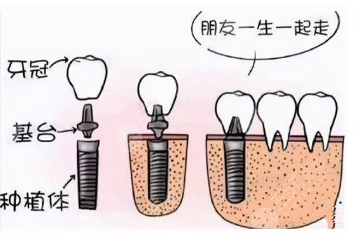 北大口腔医院种植牙价格公示
