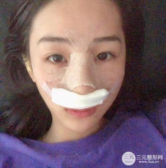 杭州恒颜医疗美容赵德星隆鼻整形手术恢复过程图