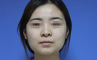 下颌骨削骨瘦脸整形手术真实案例多图对比分享