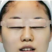 北京全切双眼皮费用2580元，割双眼皮恢复过程分享给大家