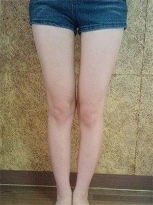 去年东方和谐张准医生做的大腿抽脂，分享一下我的前后对比果图片！