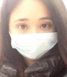 北京常好丽格割双眼皮一周啦~