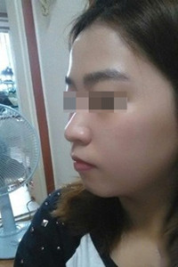 膨体隆鼻手术前后对比照片，真实案例分享！
