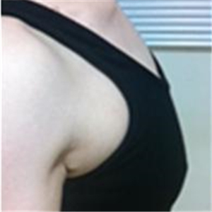 华人医联做自体脂肪隆胸三个月了，有前后对比果和恢复过程图片哦~