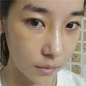 广州博仕做了隆鼻整形半年了，分享恢复过程和前后对比果照片哦~