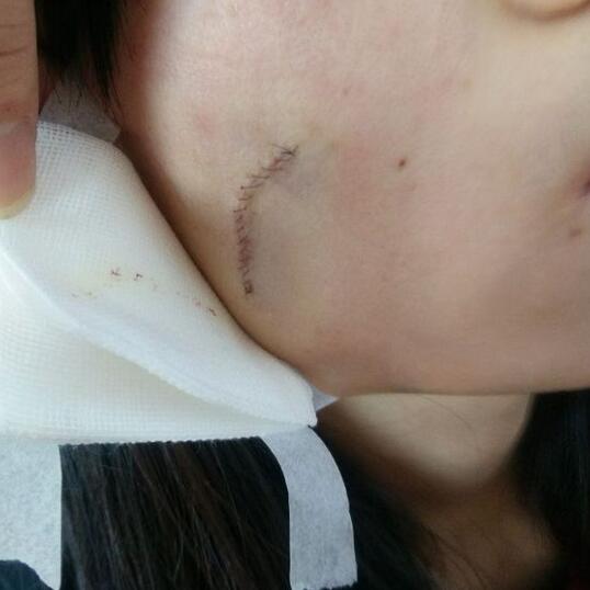 给大家看看我的脸上的手术切除祛疤过程图片