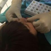 美容冠牙齿修复，缓解前后过程分享