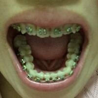 上海牙齿矫正过程分享，牙齿正畸8900元