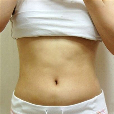 腰腹部吸脂减肥手术恢复过程和前后对比果图片分享~