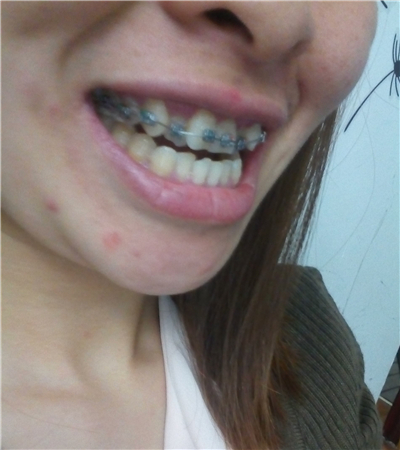 牙齿矫正手术恢复过程和前后对比果图片分享，华西做的哈~