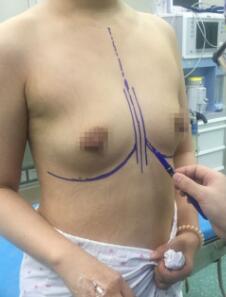 假体隆胸前的照片