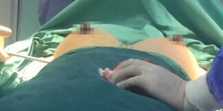 假体隆胸手术过程照片