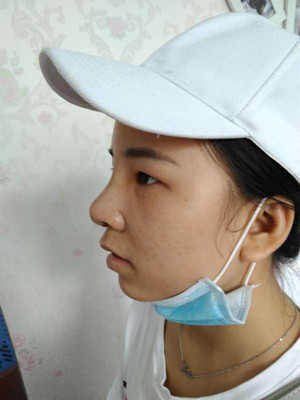 广州广美做的假体隆鼻，给大家分享一下手术前后过程以及对比照片