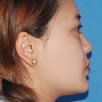 硅胶假体隆鼻+鼻翼缩小术后一个月恢复过程