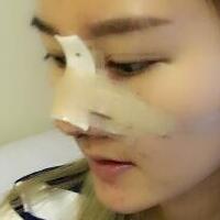 硅胶假体隆鼻过程和隆鼻前后图片，真实案例分享