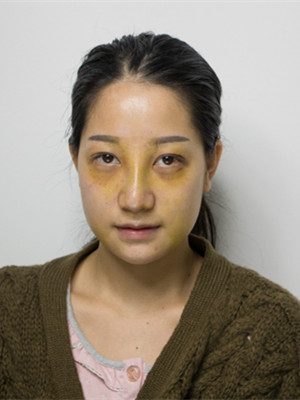 海南瑞韩刘申松做的隆鼻整形手术，附上前后对比图片