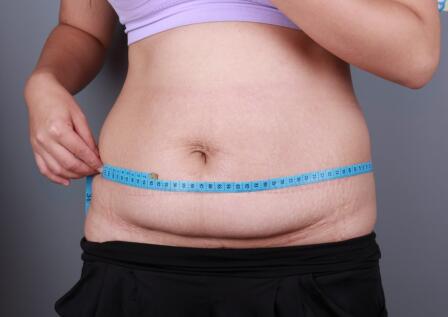 吸脂减肥瘦腰腹不反弹，恢复过程图分享