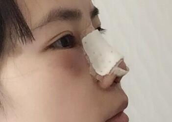 杭州悦可整形医院做隆鼻失败修复恢复过程和对比图分享