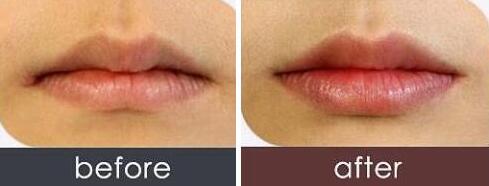 玻尿酸丰唇前后对比图，丰唇手术价格、方法