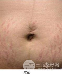果酸换肤去妊娠纹真人案例和妊娠纹整形手术前后对比图