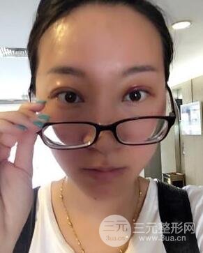 武汉叶子竺湘云给我做的切开双眼皮手术，分享一下前后对比图片