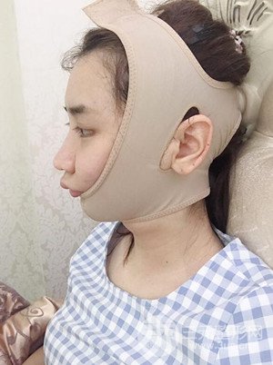 武汉一美汪国民医生做的面部吸脂【案例】，分享一下前后对比图片