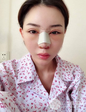 上海隆鼻失败手术修复果超乎想象、前后对比照片分享