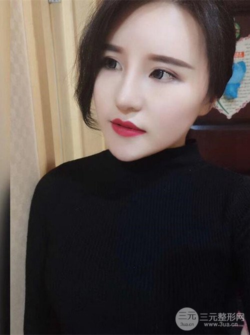 上海丽质吕成医生做的吸脂瘦脸日记，前后恢复图分享