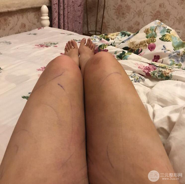 德阳东美奥克拉杨华博大腿吸脂前后对比图 四个月恢复变化小记