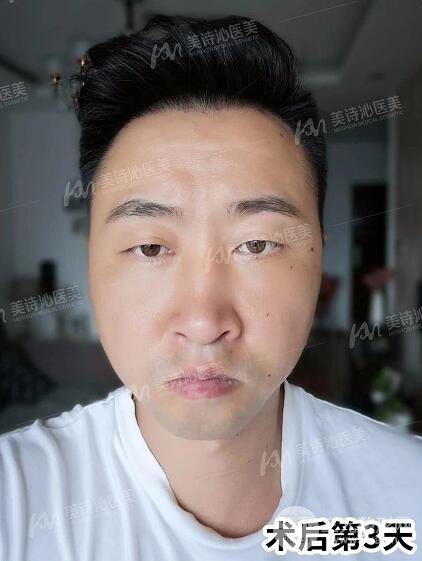 北京诗美沁祛眼袋案例，男士微创祛眼袋果分享！