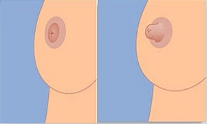 女性乳头内陷的原因是什么 女性乳头内陷怎么办