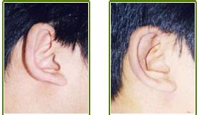 杯状耳怎么矫正 杯状耳矫正术的适应症