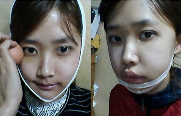 在北京艺星医疗美容医院做下颌角整形手术真实经历