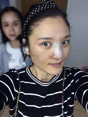 北京常好丽格做假体隆鼻3个月