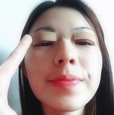 广州凯美达微创双眼皮手术恢复期纪实