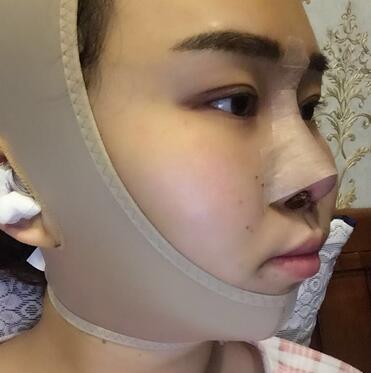 上海余天成二次鼻修复恢复日记 隆鼻整形修复+下巴吸脂