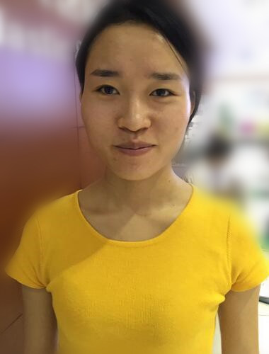 北京八大处张智勇V-line瓜子脸手术前后对比