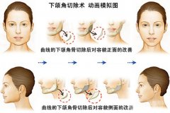 北京八大处做的下颌角整形手术降低风险吗，果怎么样