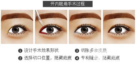 详解:韩式微创开眼角手术,附案例果对比图片恢复过程分享